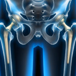 Hüftprothese: Risiken und Chancen einer Operation Hüftprothese