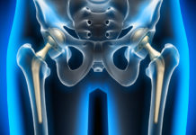 Hüftprothese: Risiken und Chancen einer Operation Hüftprothese