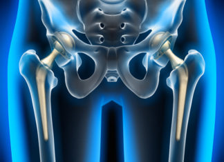 Hüftprothese: Risiken und Chancen einer Operation Hüftprothese