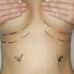 Mammaaugmentation – die OP zur Vergrößerung der Brust Brustvergrößerung