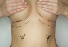 Mammaaugmentation – die OP zur Vergrößerung der Brust Brustvergrößerung