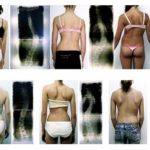 Verkrümmung der Wirbelsäule – Die Skoliose Patientinnen mit Skoliose