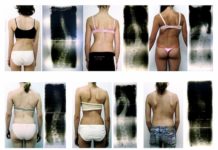 Verkrümmung der Wirbelsäule – Die Skoliose Patientinnen mit Skoliose