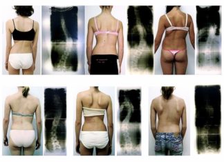 Verkrümmung der Wirbelsäule – Die Skoliose Patientinnen mit Skoliose