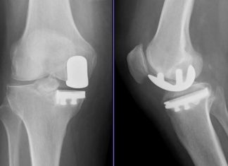 Diese Knieprothesen werden häufig verwendet Knieprothese